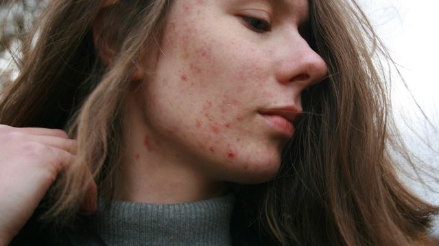 Acne and Diet: The Gut-Skin Connection Your Dermatologist Missed