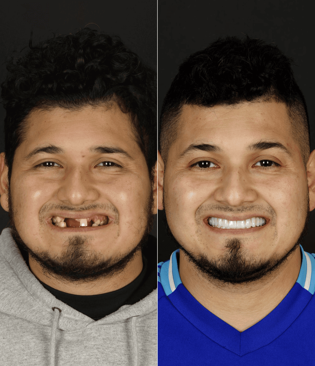 Before and after smile makeover at Bensonhurst Dental in Brooklyn: man with missing front teeth restored to a full smile