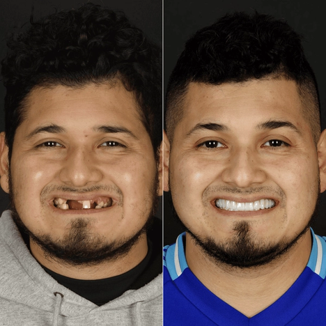 Before and after smile makeover at Bensonhurst Dental in Brooklyn: man with missing front teeth restored to a full smile