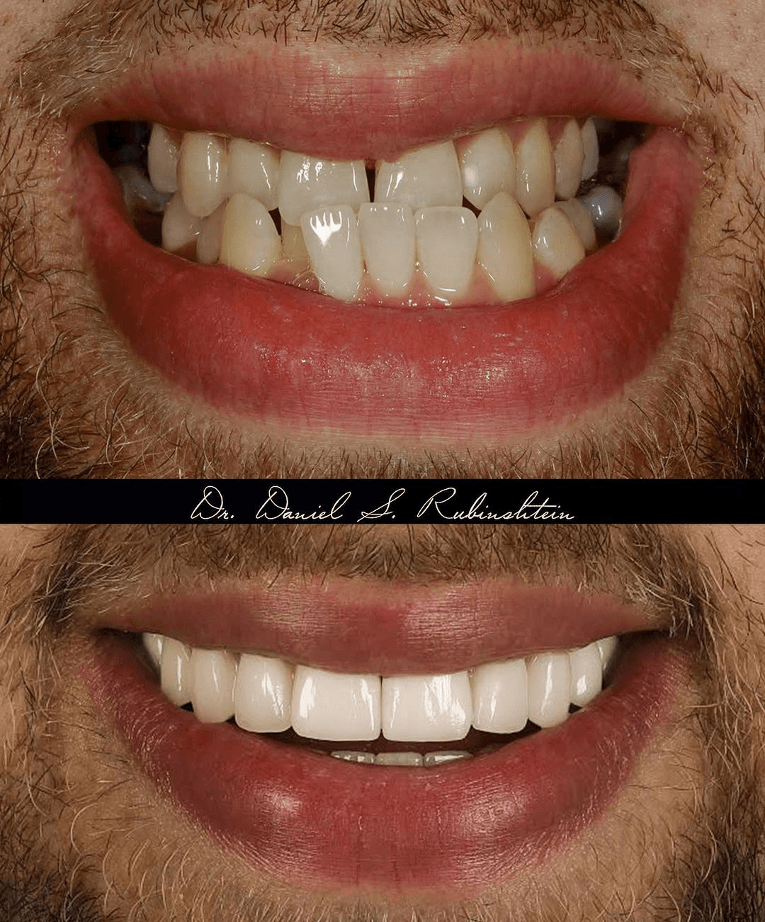 Before and after close-up: crooked, worn teeth replaced with an even, white smile