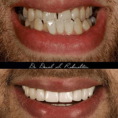 Before and after close-up: crooked, worn teeth replaced with an even, white smile