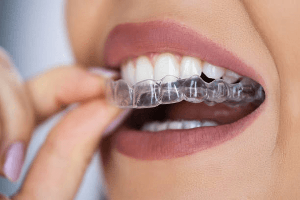 Woman placing a clear aligner on her teeth