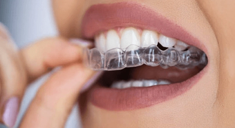 Woman placing a clear aligner on her teeth