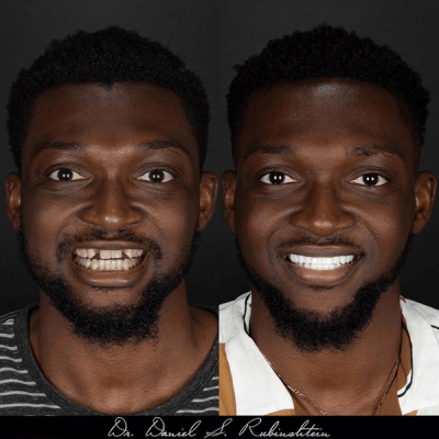 Before and after smile makeover at Bensonhurst Dental in Brooklyn: man with chipped and missing front teeth restored