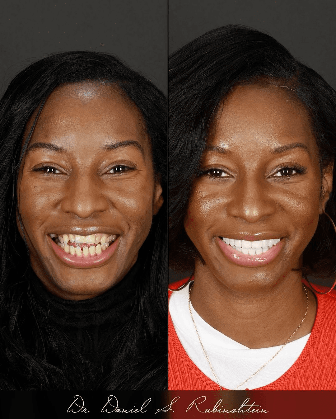 Before and after smile makeover at Bensonhurst Dental in Brooklyn: woman with uneven teeth restored to an even, white smile