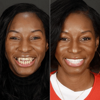Before and after smile makeover at Bensonhurst Dental in Brooklyn: woman with uneven teeth restored to an even, white smile