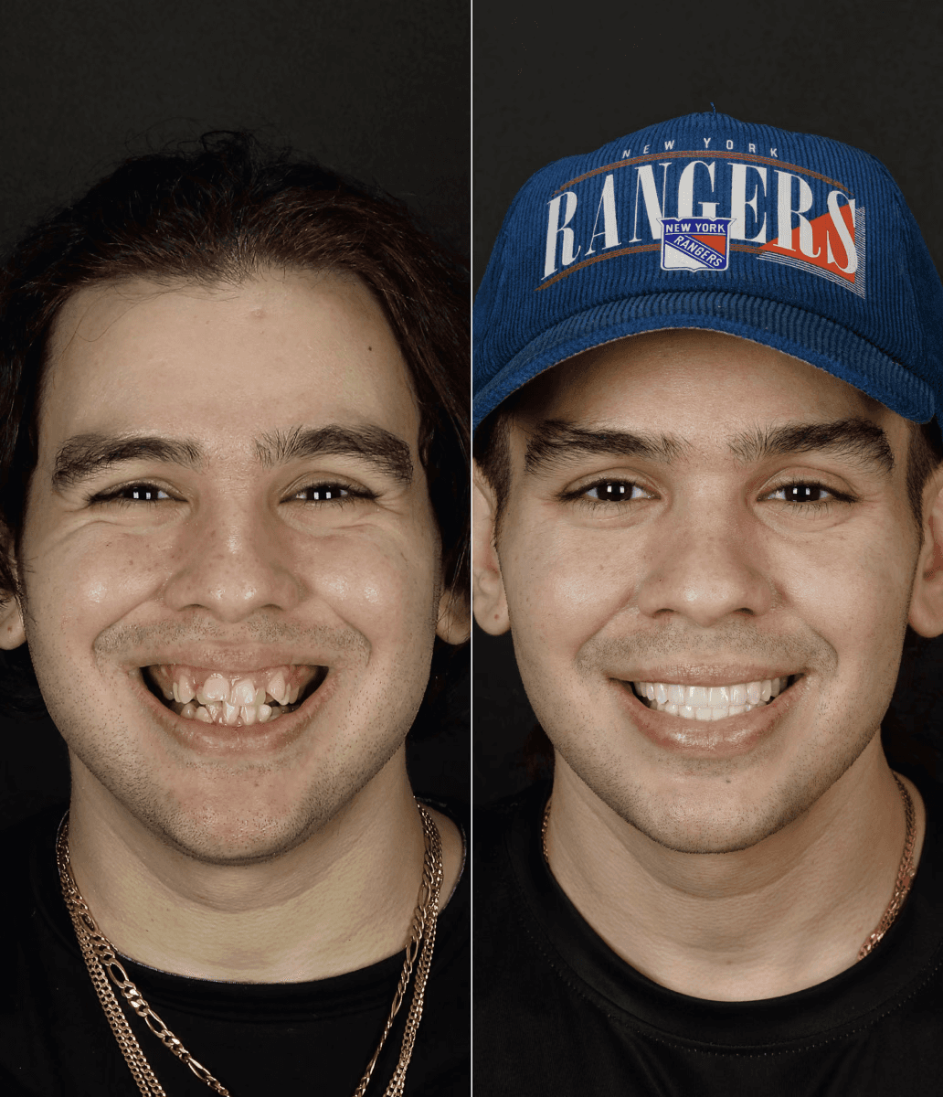 Before and after smile makeover at Bensonhurst Dental in Brooklyn: young man with crowded teeth given a straight, white smile