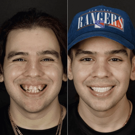 Before and after smile makeover at Bensonhurst Dental in Brooklyn: young man with crowded teeth given a straight, white smile