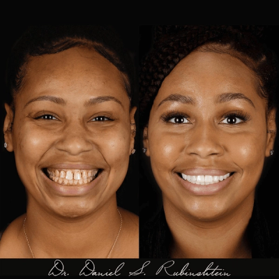 Before and after smile makeover at Bensonhurst Dental in Brooklyn: woman with gaps between her front teeth closed