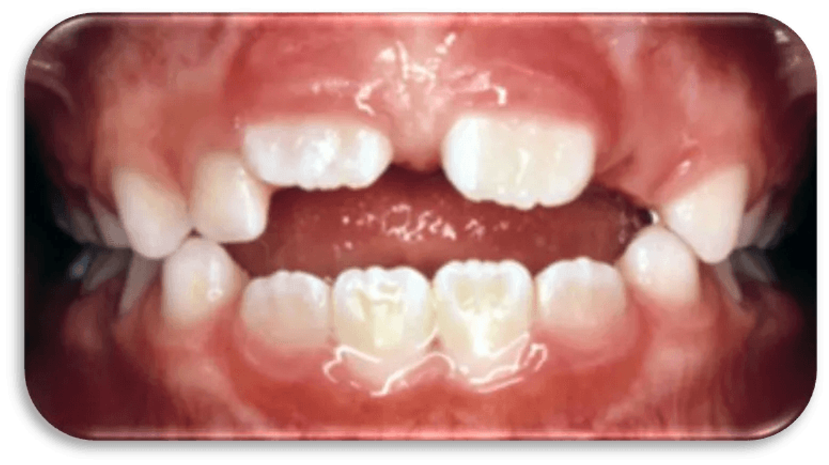 Child's teeth with an open bite caused by oral habits