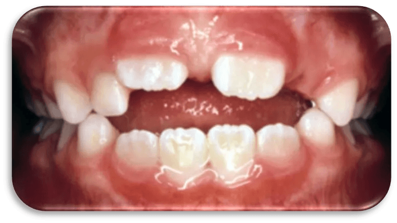 Child's teeth with an open bite caused by oral habits
