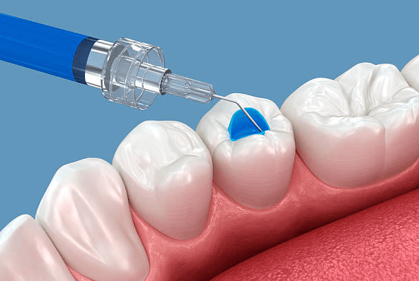 Illustration of a dental sealant being applied to a molar