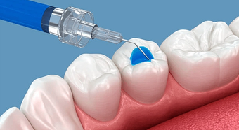 Illustration of a dental sealant being applied to a molar
