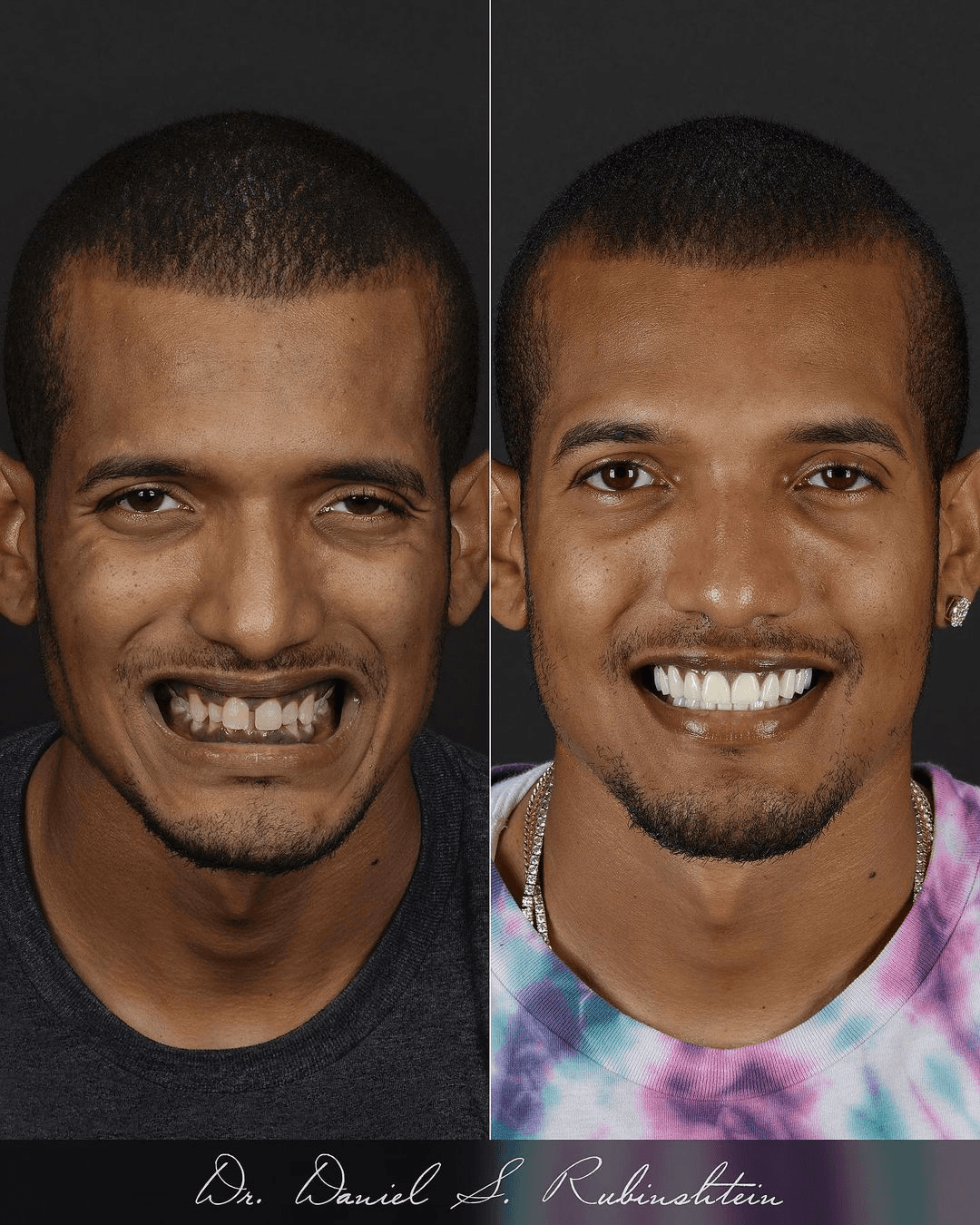 Before and after smile makeover at Bensonhurst Dental in Brooklyn: man with gaps and worn teeth given a full, white smile