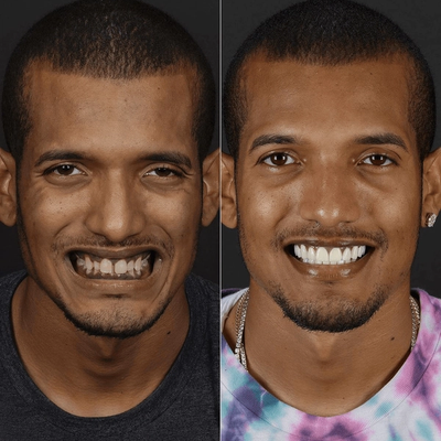 Before and after smile makeover at Bensonhurst Dental in Brooklyn: man with gaps and worn teeth given a full, white smile