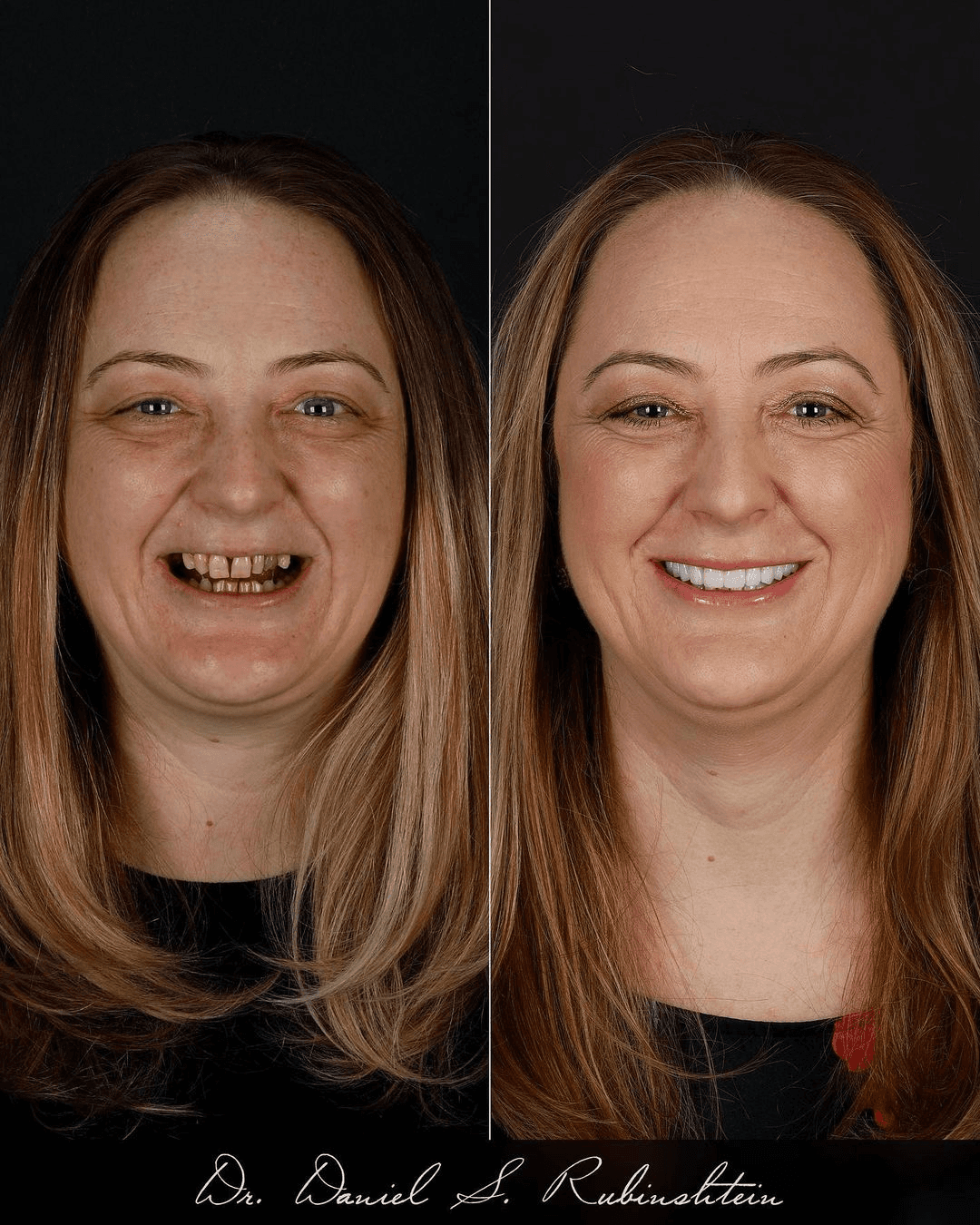 Before and after smile makeover at Bensonhurst Dental in Brooklyn: woman with worn, stained teeth restored to a bright, even smile