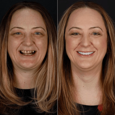Before and after smile makeover at Bensonhurst Dental in Brooklyn: woman with worn, stained teeth restored to a bright, even smile
