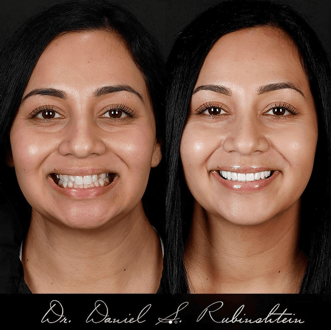 Before and after smile makeover at Bensonhurst Dental in Brooklyn: woman with crooked teeth given a straight, white smile