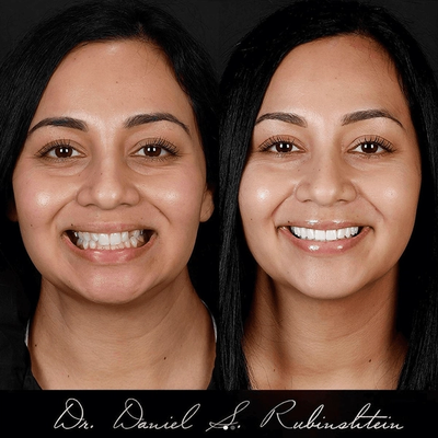 Before and after smile makeover at Bensonhurst Dental in Brooklyn: woman with crooked teeth given a straight, white smile