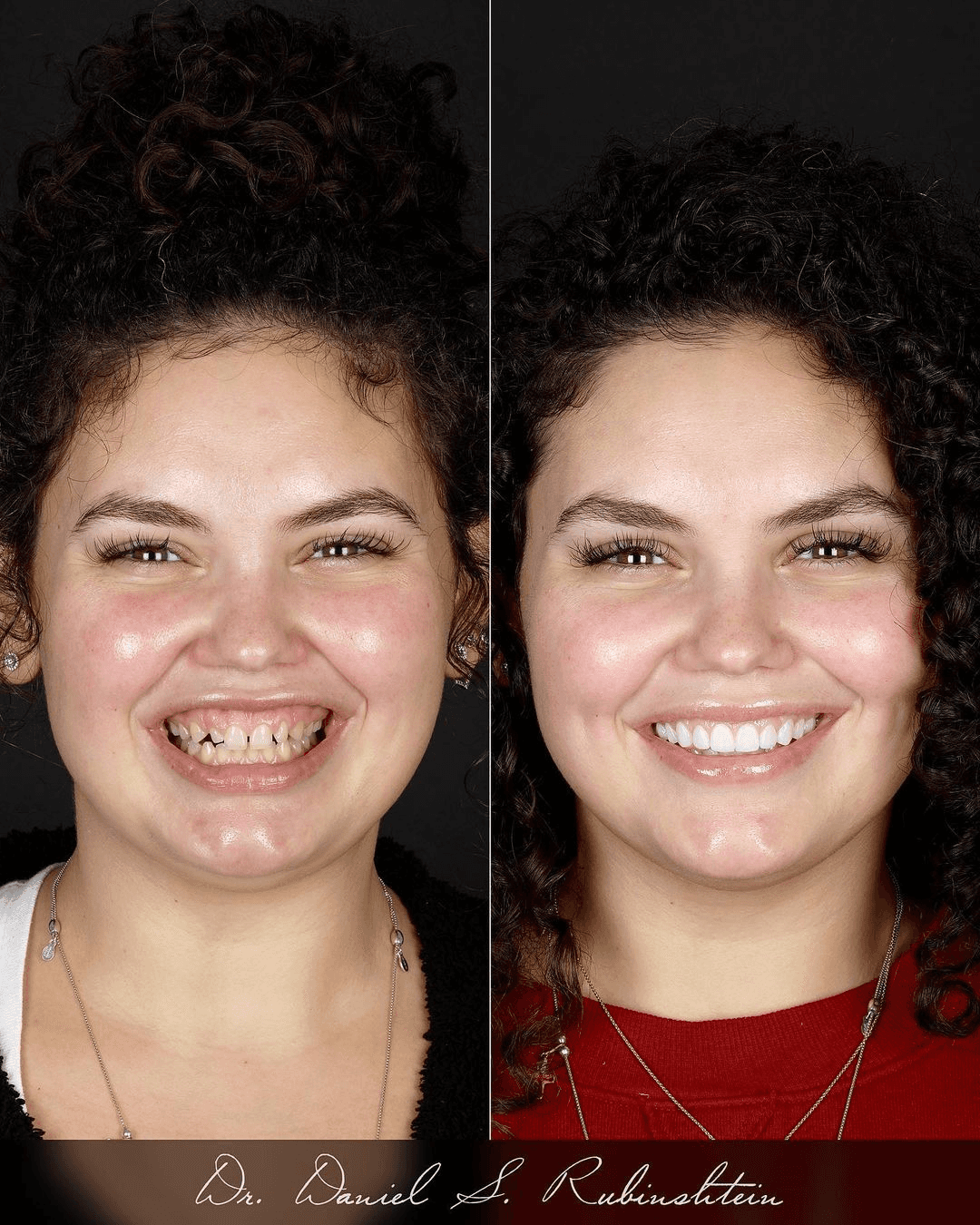 Before and after smile makeover at Bensonhurst Dental in Brooklyn: young woman with gaps between her teeth given an even smile