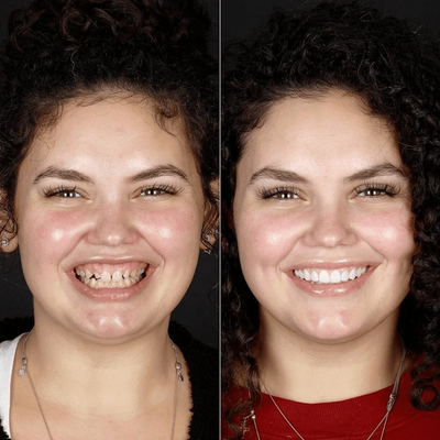Before and after smile makeover at Bensonhurst Dental in Brooklyn: young woman with gaps between her teeth given an even smile