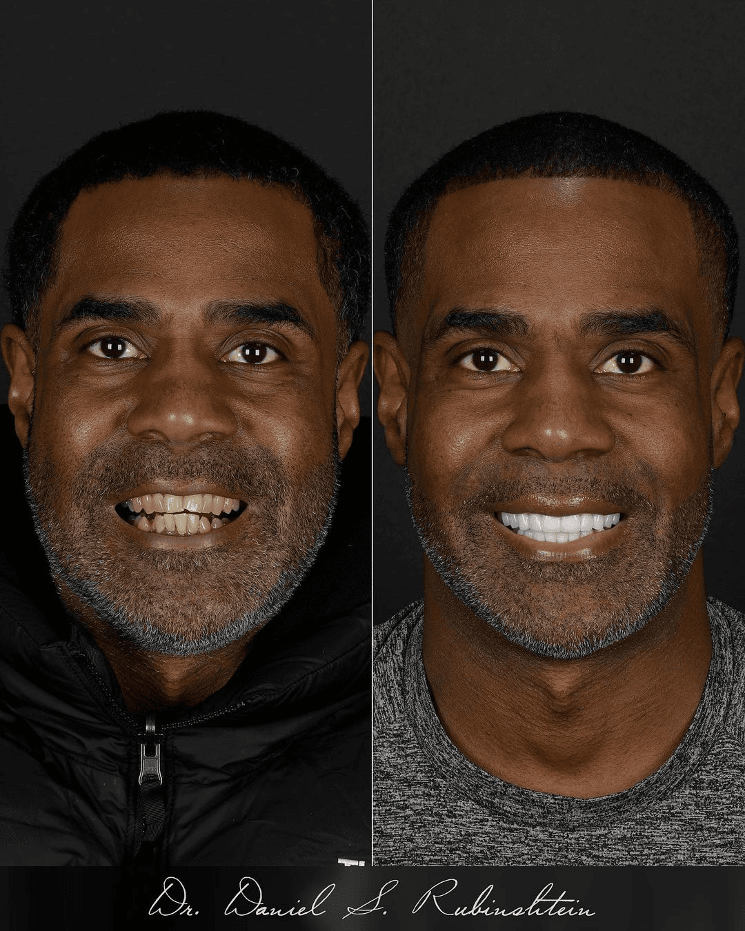 Before and after smile makeover at Bensonhurst Dental in Brooklyn: man with stained, uneven teeth given a bright, even smile
