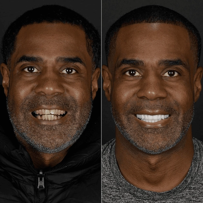 Before and after smile makeover at Bensonhurst Dental in Brooklyn: man with stained, uneven teeth given a bright, even smile