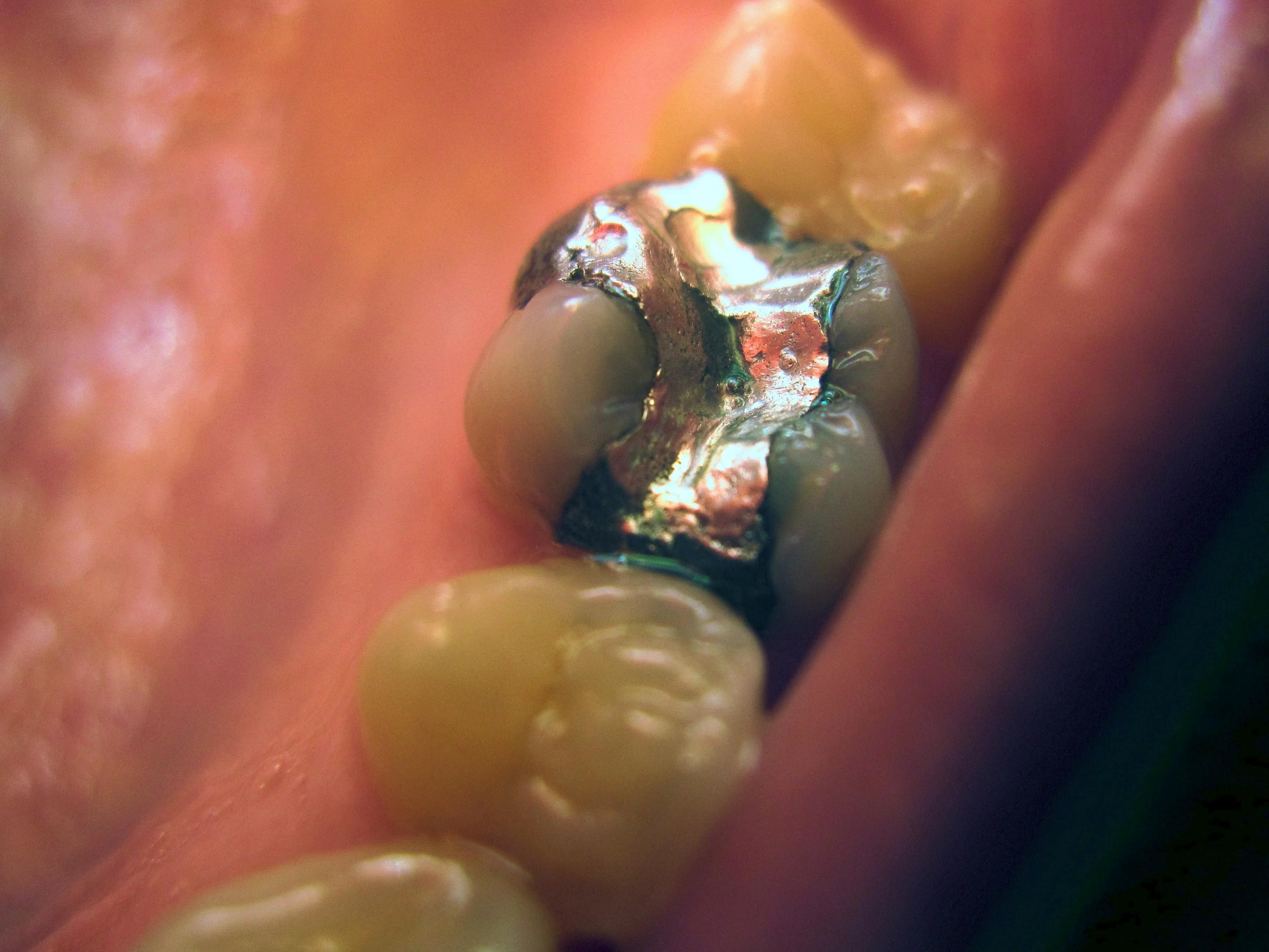 Close-up of an old silver amalgam filling in a molar