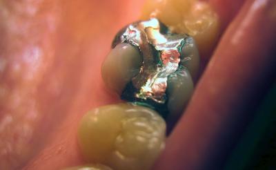 Close-up of an old silver amalgam filling in a molar