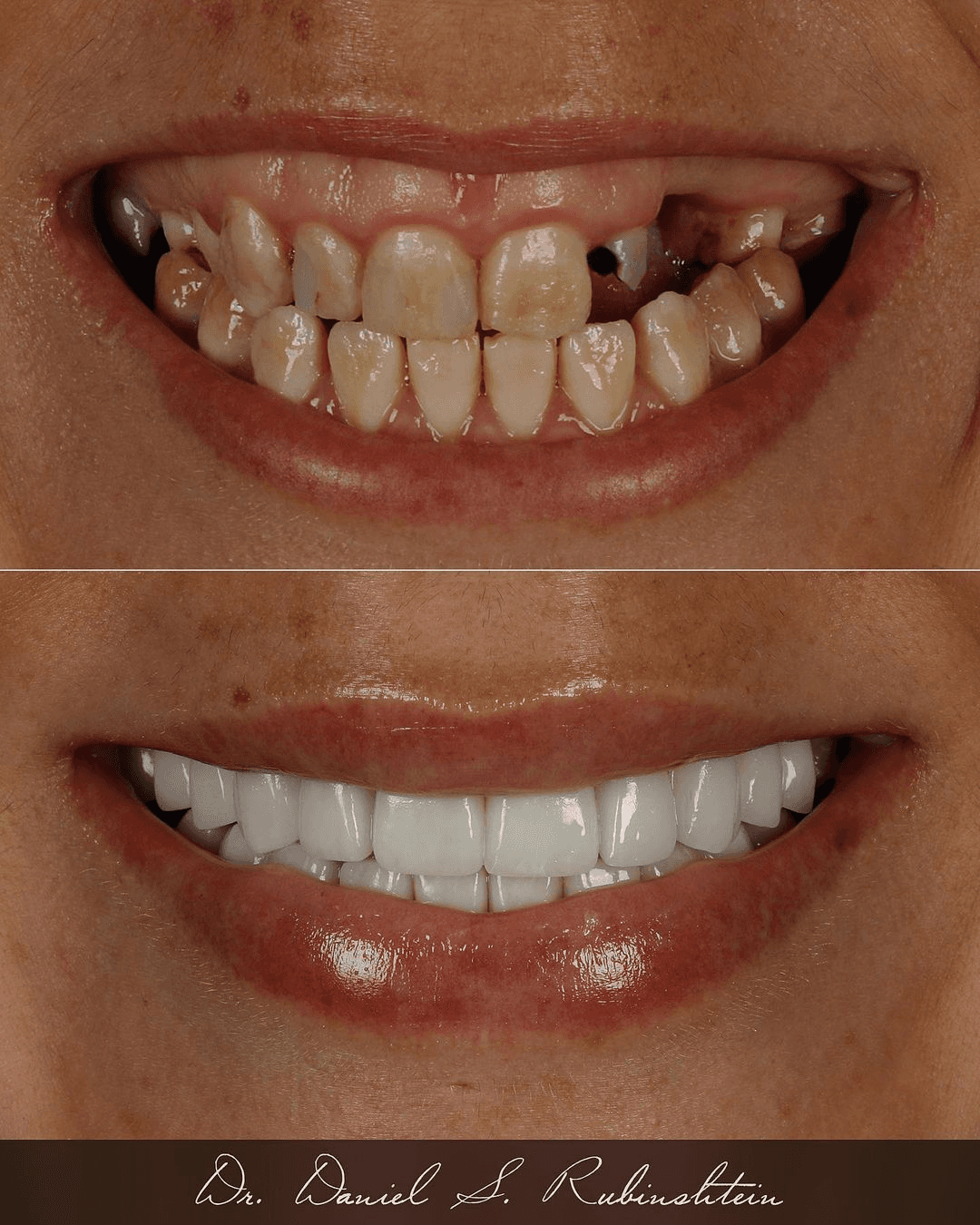 Before and after close-up: decayed and missing teeth restored to a full smile