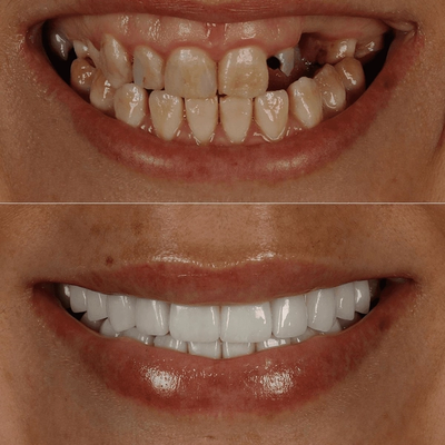 Before and after close-up: decayed and missing teeth restored to a full smile