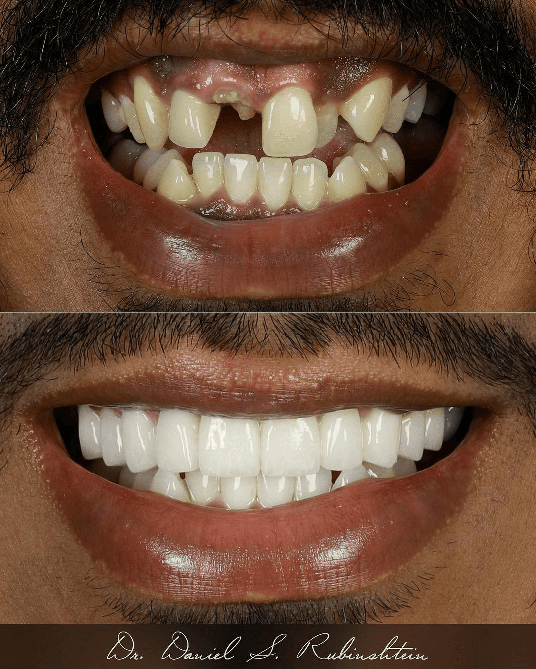 Before and after close-up: missing front tooth and gaps restored with porcelain