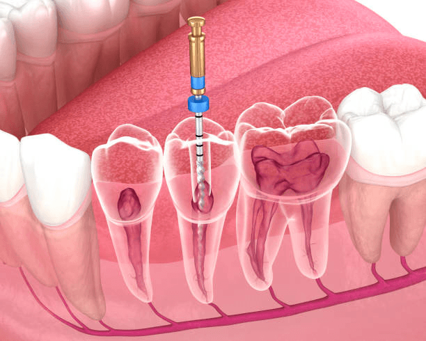 Illustration of a root canal treatment on a molar