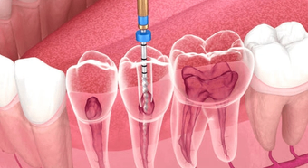 Illustration of a root canal treatment on a molar