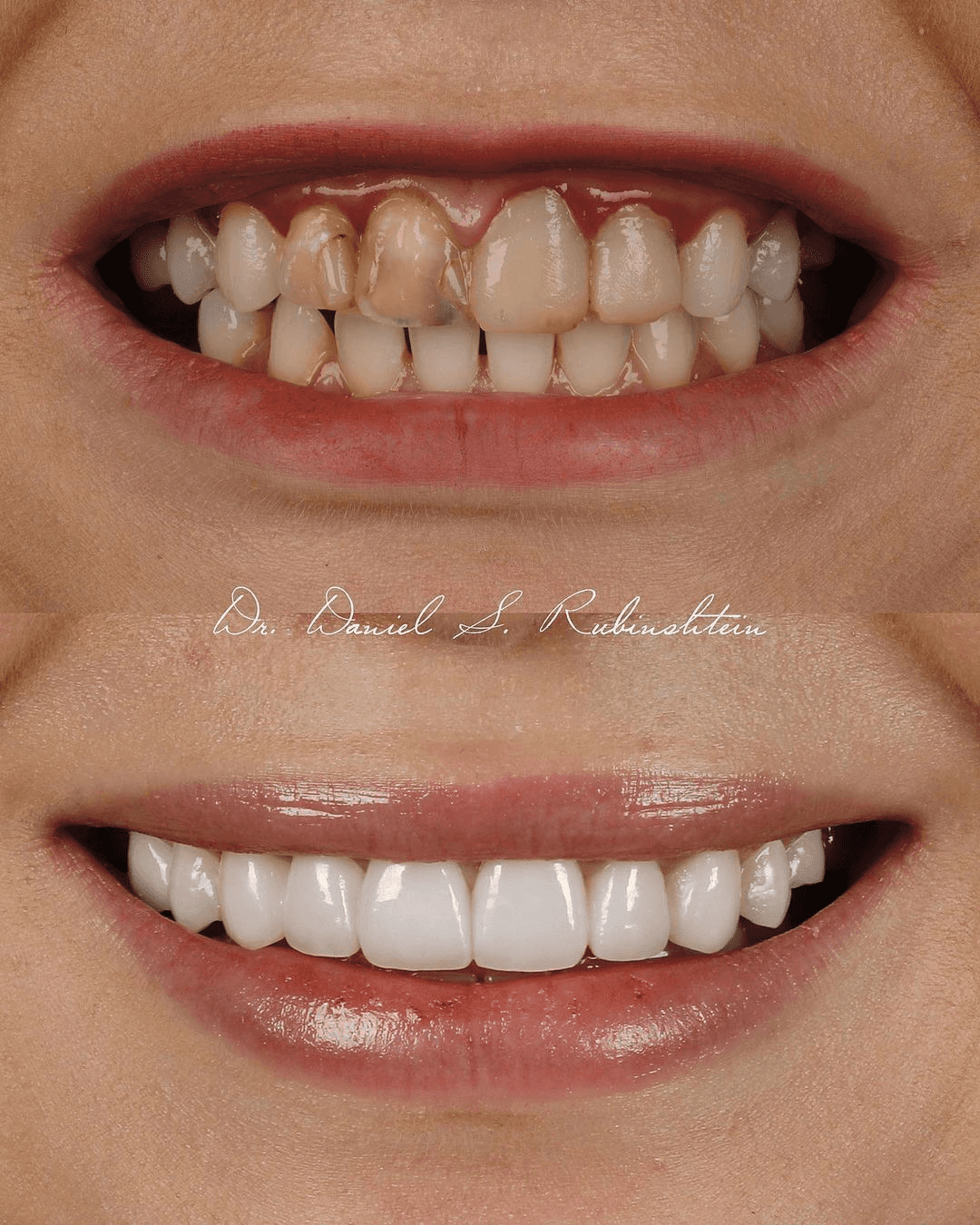 Before and after close-up: discolored front tooth and uneven teeth restored with veneers