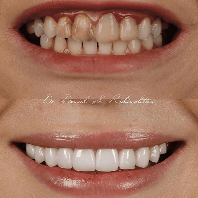 Before and after close-up: discolored front tooth and uneven teeth restored with veneers