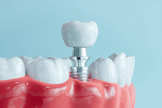 Model of a dental implant with a crown