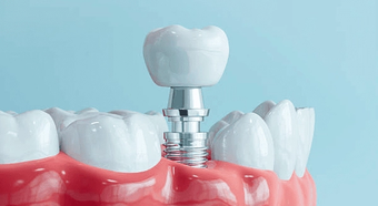 Model of a dental implant with a crown