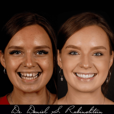 Before and after smile makeover at Bensonhurst Dental in Brooklyn: woman with crowded, spaced teeth given an even smile