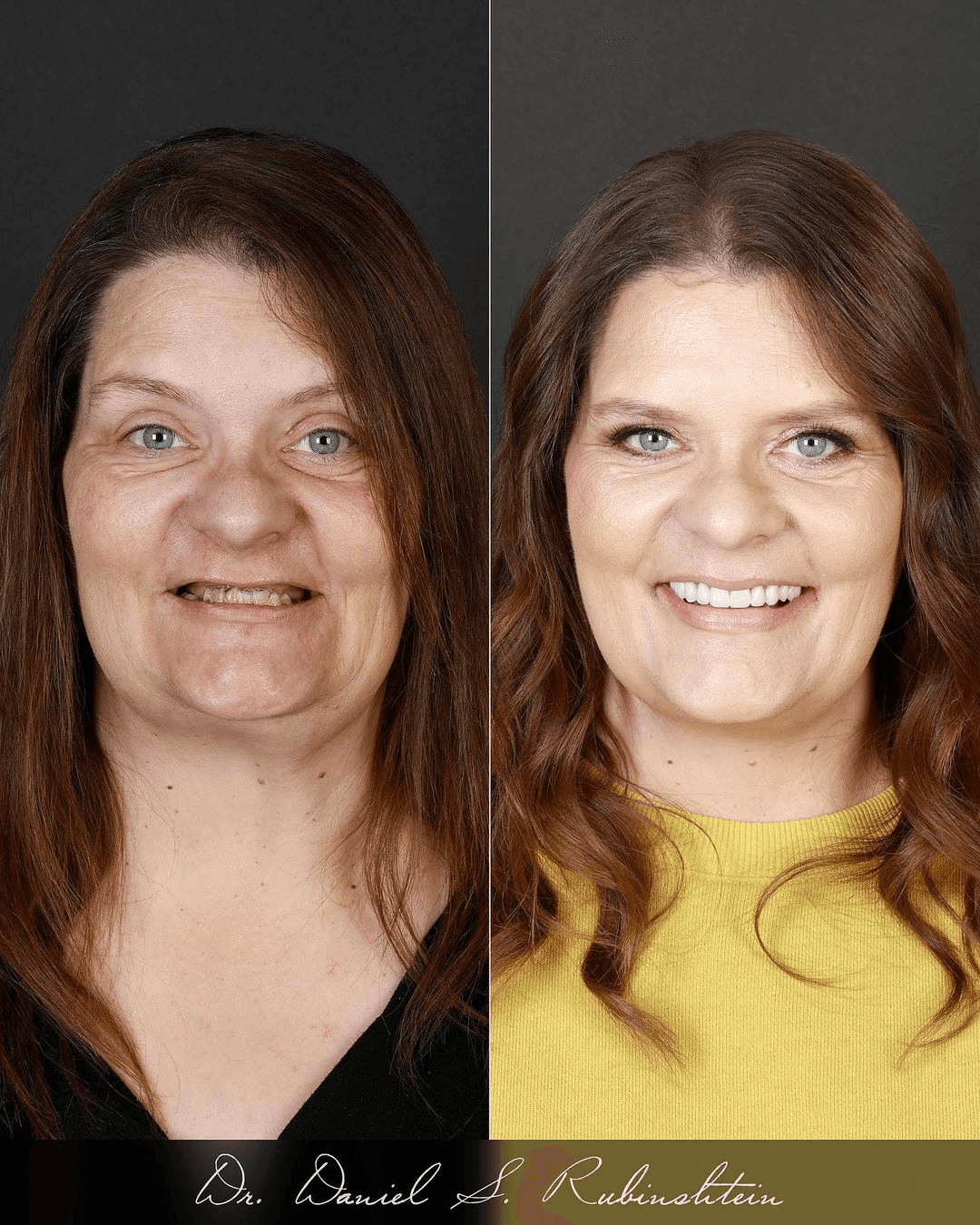 Before and after smile makeover at Bensonhurst Dental in Brooklyn: woman with missing and worn teeth restored to a full smile