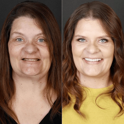 Before and after smile makeover at Bensonhurst Dental in Brooklyn: woman with missing and worn teeth restored to a full smile
