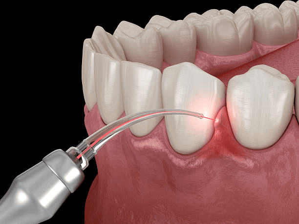 Illustration of a dental laser treating the gums