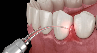 Illustration of a dental laser treating the gums