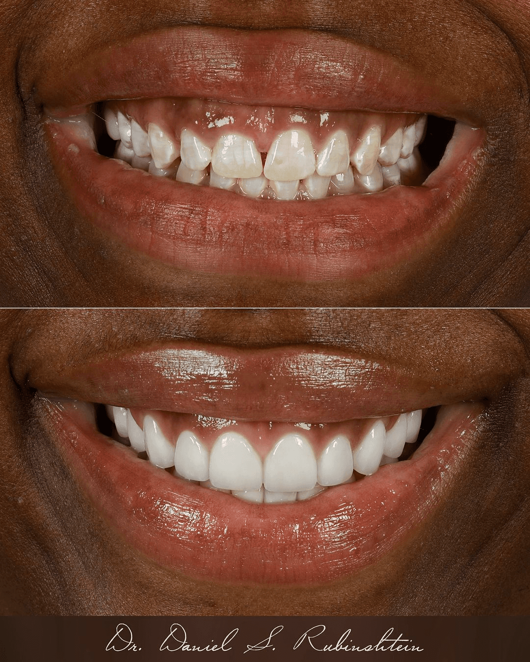 Before and after close-up: chipped, uneven teeth restored to a white, even smile