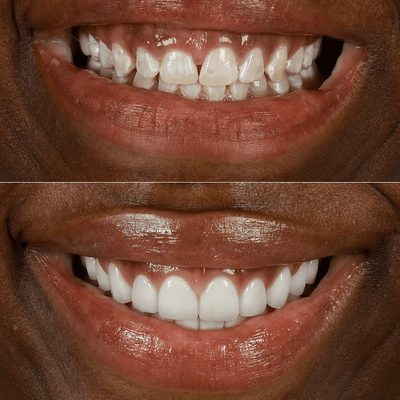 Before and after close-up: chipped, uneven teeth restored to a white, even smile