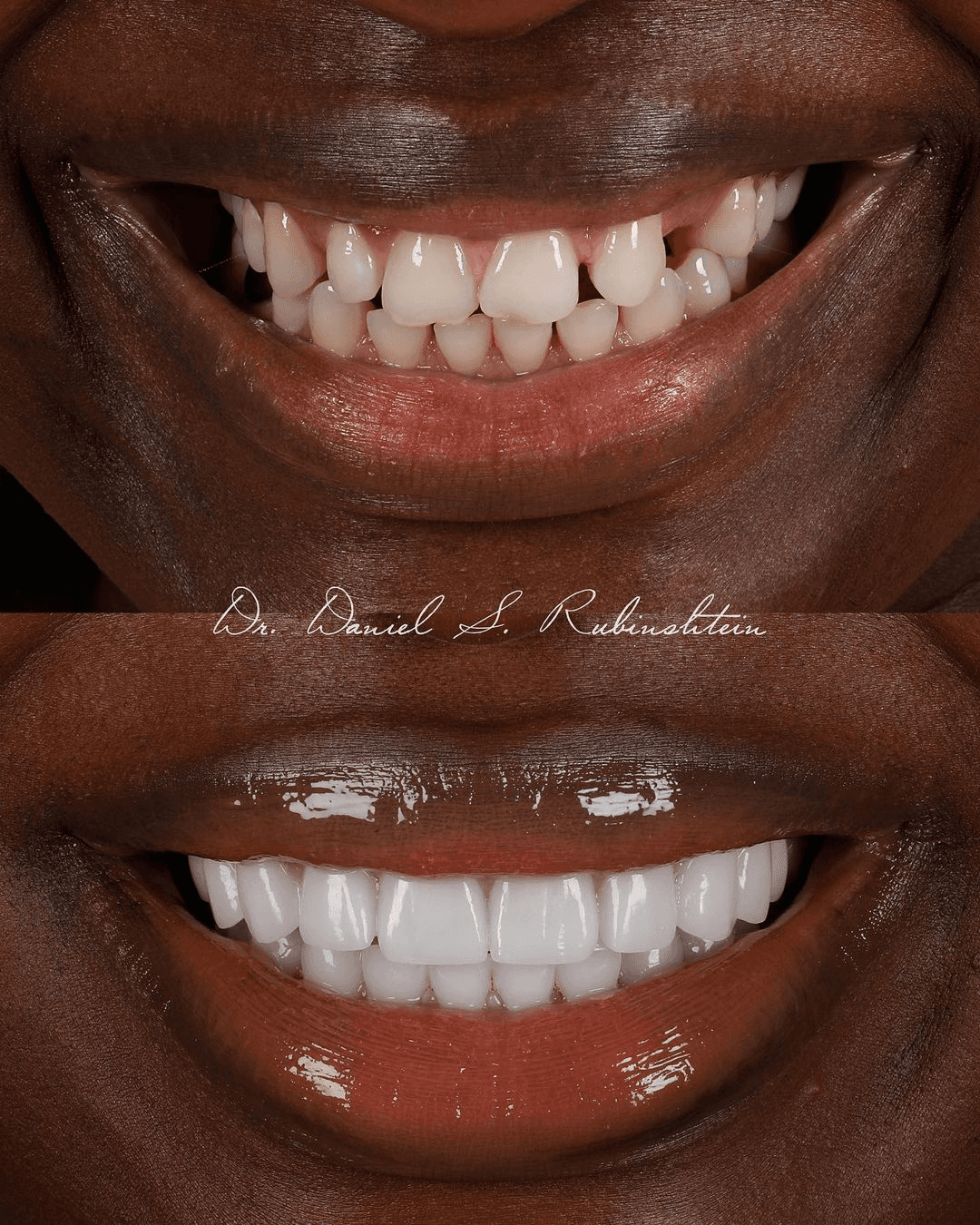 Before and after close-up: gaps between teeth closed for an even smile