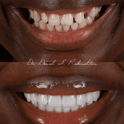 Before and after close-up: gaps between teeth closed for an even smile