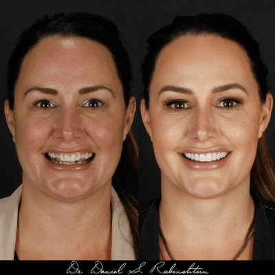 Before and after smile makeover at Bensonhurst Dental in Brooklyn: woman with small, uneven teeth given a balanced, white smile