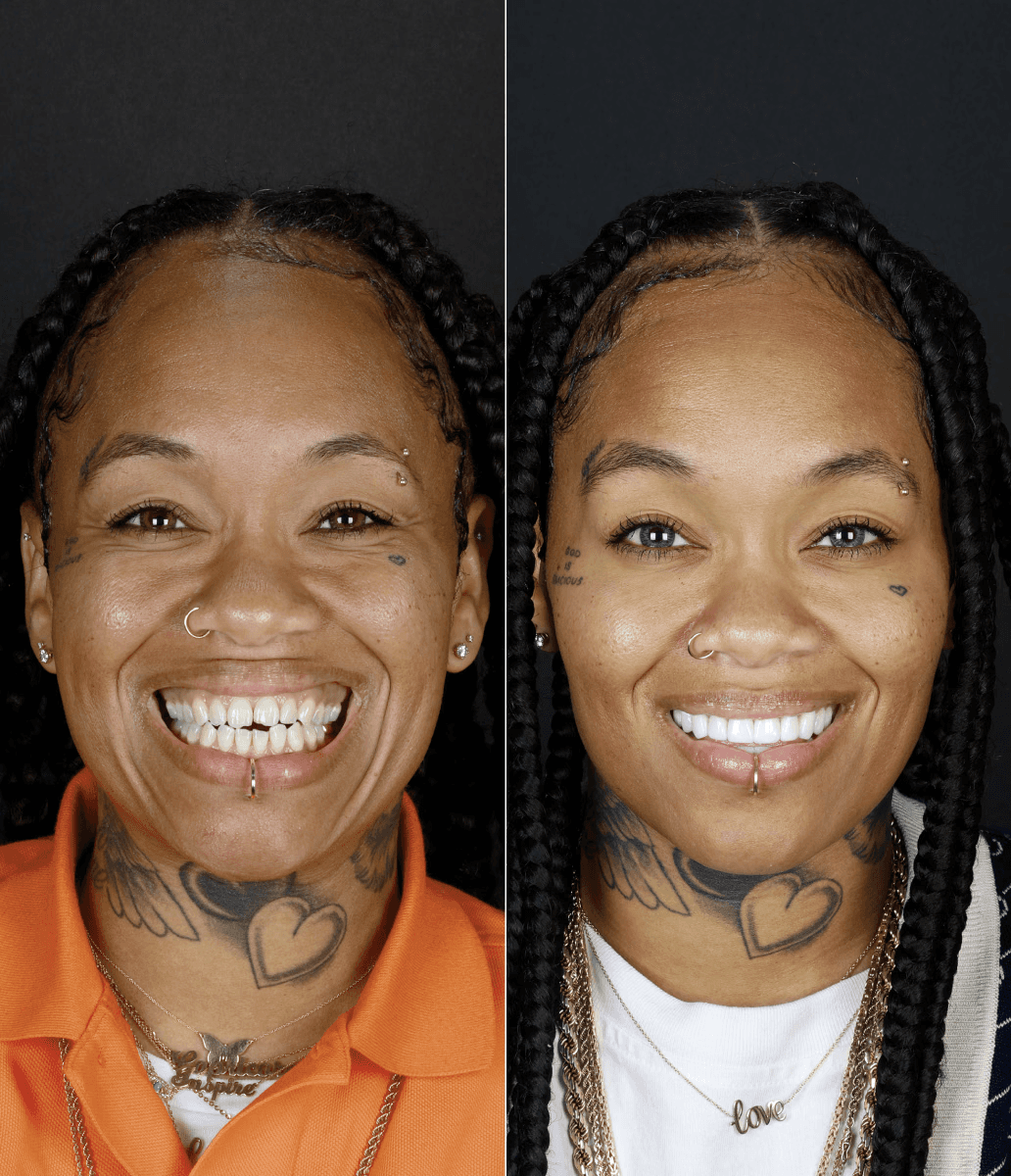 Before and after smile makeover at Bensonhurst Dental in Brooklyn: woman with uneven teeth given a bright, even smile