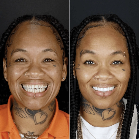 Before and after smile makeover at Bensonhurst Dental in Brooklyn: woman with uneven teeth given a bright, even smile